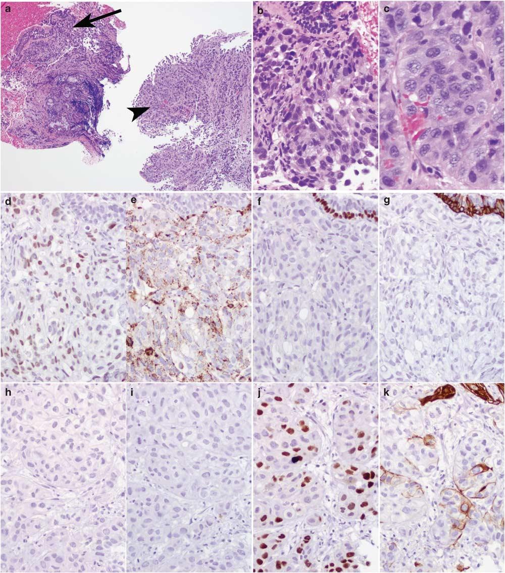 Small biopsies of lung nodules S51 Figure 8 Immunohistochemical findings in poorly differentiated adenosquamous carcinoma in a small biopsy.