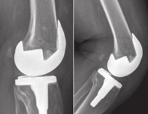 fixed bearing ps constrained genesis ii total knee arthroplasty 751 A Fig. 2.