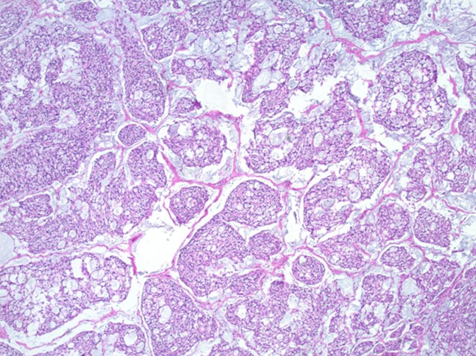 Figure 3. H&E stained sections of surgically resected tumor ( 40) showed numerous microcystic structures formed by spindle cells, architecturally demonstrating a plexiform growth pattern. Figure 5.