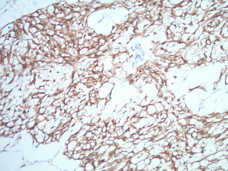 The lesion was composed of bland-looking spindle cells connected by complex weblike maximal eosinophilic cytoplasmic extensions. Myxoid substance was present intracellularly and extracellularly.