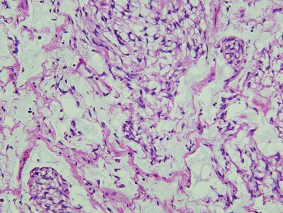 IHC stains showed that the tumor cells were positive for S-100 protein and negative for AE1/AE3, CAM 5.2, SMA, CD34, and p63.