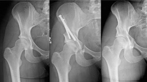 The Birmingham Interlocking Pelvic Osteotomy (BIPO) for Acetabular Dysplasia: 13 to 21 Year Survival Outcomes Omer Mei-Dan, MD Dylan Jewell, BSc,