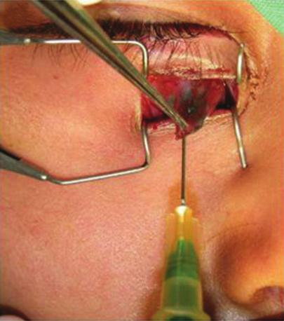Surgical approach was via a skin incision or through the conjunctiva in the fornix.
