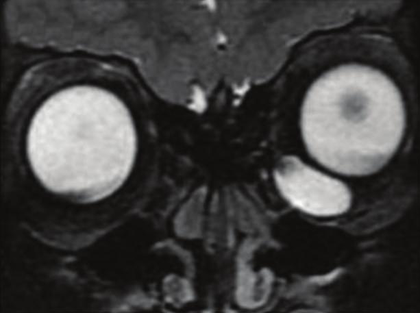Ophthalmology 3 (a) (b) (c) (d) Figure 2: (a) T2 Coronal MRI scan showing a 1.5 cm inferomedial cystic mass in the left orbit. (b) Cyst exposure through a conjunctival incision.