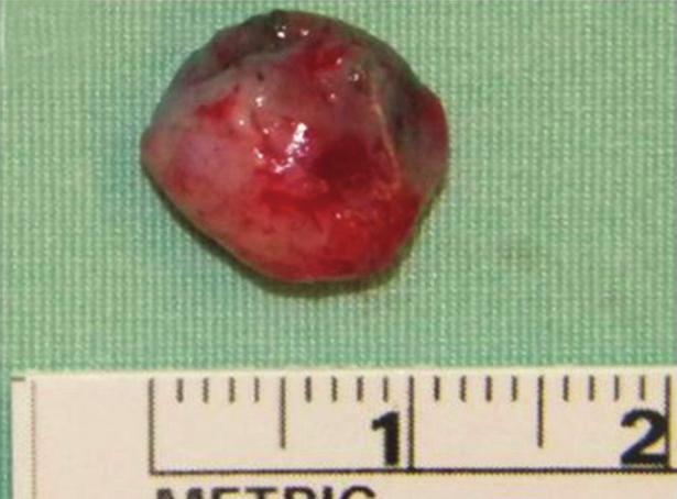 Upon further exposure, the cyst startedtolosevolume,andthereforeicgwasinjectedinto the cyst, which allowed improved visualization of the lesion boundaries (Figures 1(c) and 1(d)) permitting its