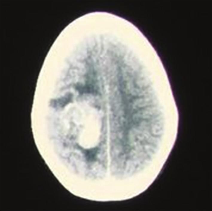 2 Case Reports in Medicine Figure 1: Preoperative CT scan brain showing a calcified