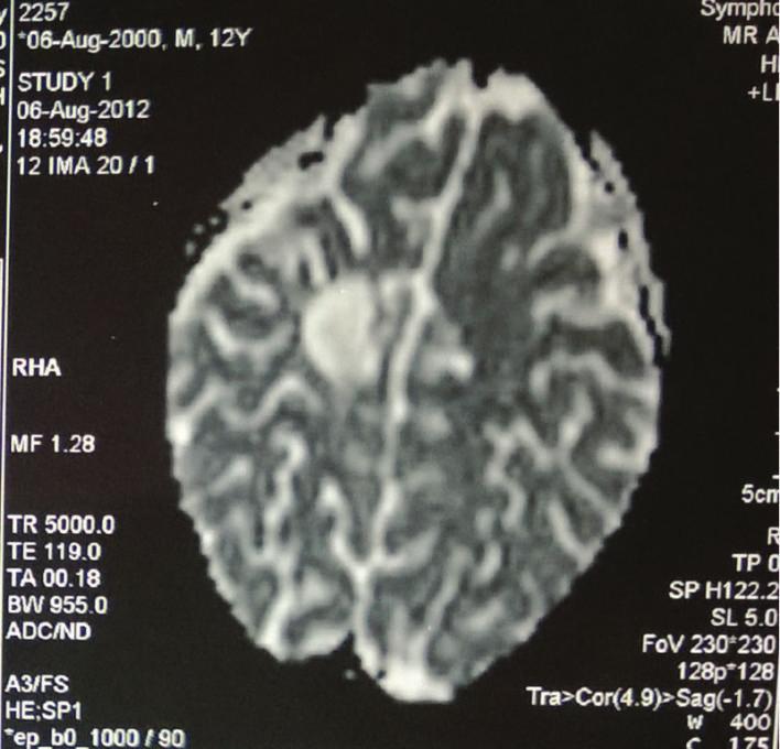 4 Case Reports in Medicine Figure 11: CT scan residual tumor 2012. Figure 12: CT scan brain with residual tumor in the right temporoparietal region May 2014.