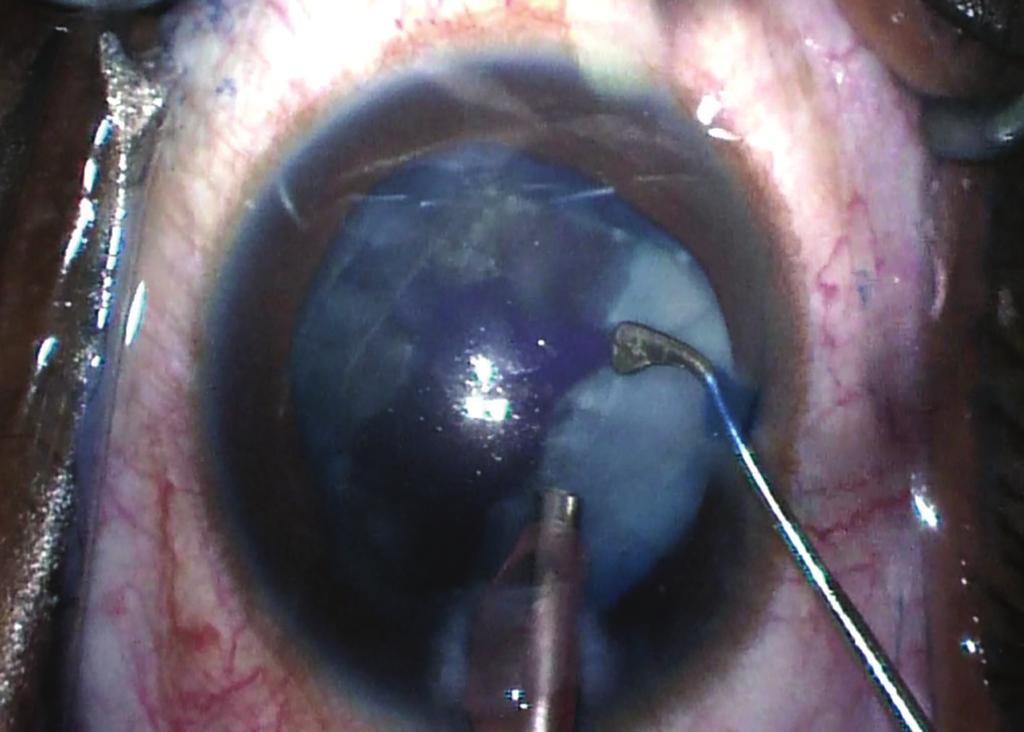 Note the trypan blue staining on the formerly posterior surface of the lens fragment.