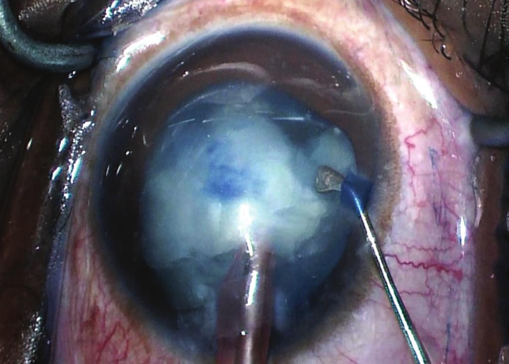 Figure 2: Trypan blue dye is noted on the posterior capsule during phacoemulsification. (Figure 3). The remaining cortex was removed with irrigation and aspiration without incident (Figure 4).