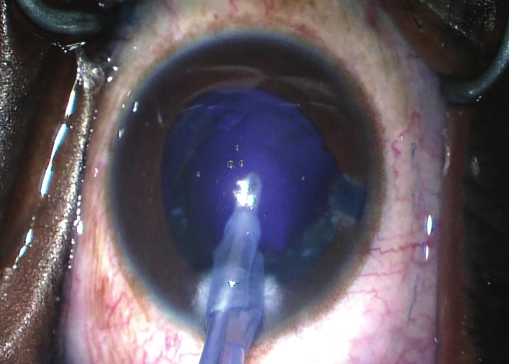 The capsular bag was inflated using Provisc and an SN60WF one-piece intraocular lens (Alcon Laboratories, Inc., Fort Worth, Texas) was inserted into the capsular bag.