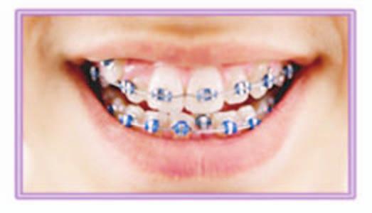 Introduction The proportional relationship between the sizes of upper and lower teeth was accepted as an important index by which an orthodontist can determine the possible functional and esthetic
