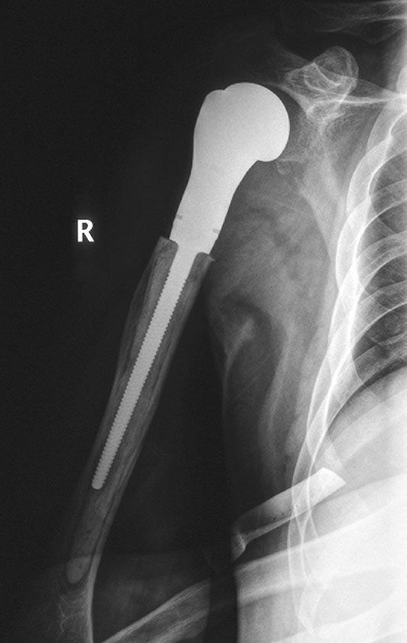 (A) Partial recovery of shoulder abduction was evident at 3 months, and almost full recovery of shoulder ROM was seen on (B) abduction, (C) forward extension, and (D) elevation at the 12-month