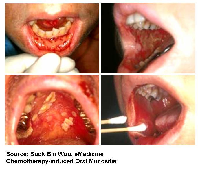 Oral Mucositis Patients developing severe Oral Mucositis (%) 70 Placebo 60