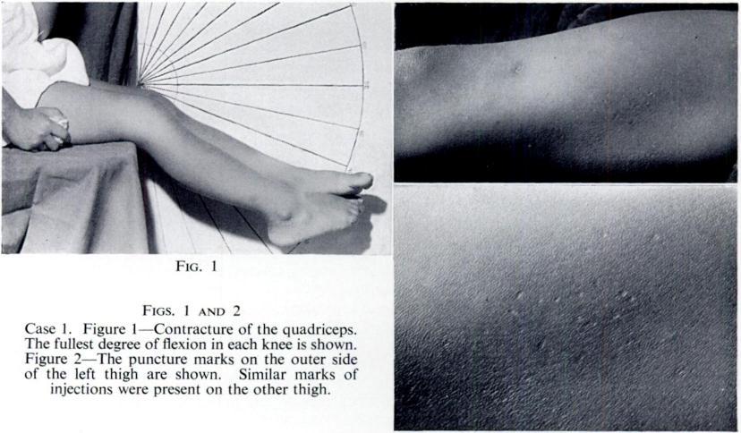 CONTRACTURE OF THE QUADRICEPS MUSCLE 493 The fibrotic change was greatest at about the mid-thigh level or distal to it and on no occasion was it noted that the proximal portion was fibrotic, although