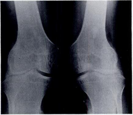 CONTRACTURE OF THE QUADRICEPS MUSCLE 497 and division of the ilio-tibial tract alone did not prevent redislocation of the patella.