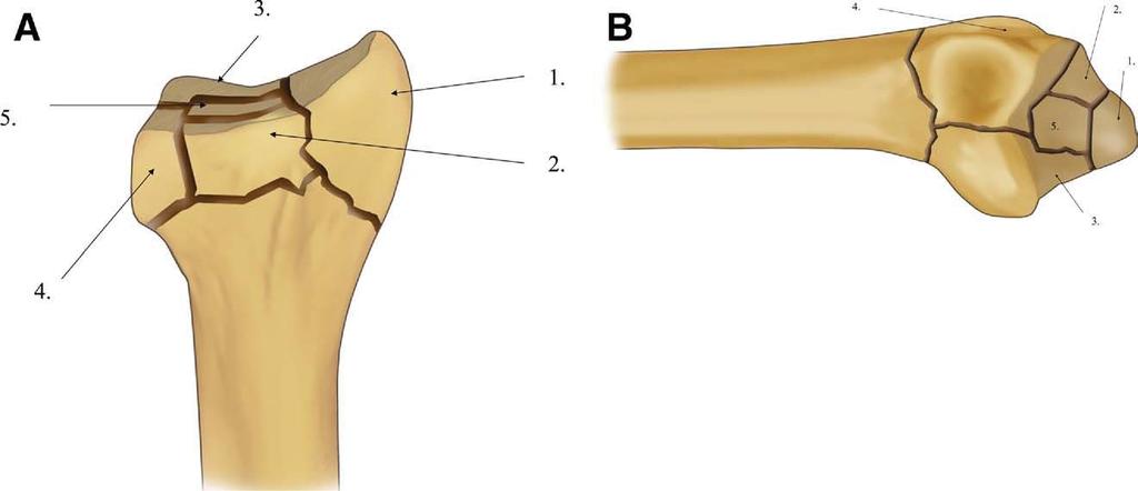 182 J. Lam and S.W. Wolfe Figure 1 (A) Posteroanterior and (B) medial view of the critical fragments: (1) radial column, (2) dorsal wall, (3) volar rim, (4) ulnar corner, and (5) impacted articular.
