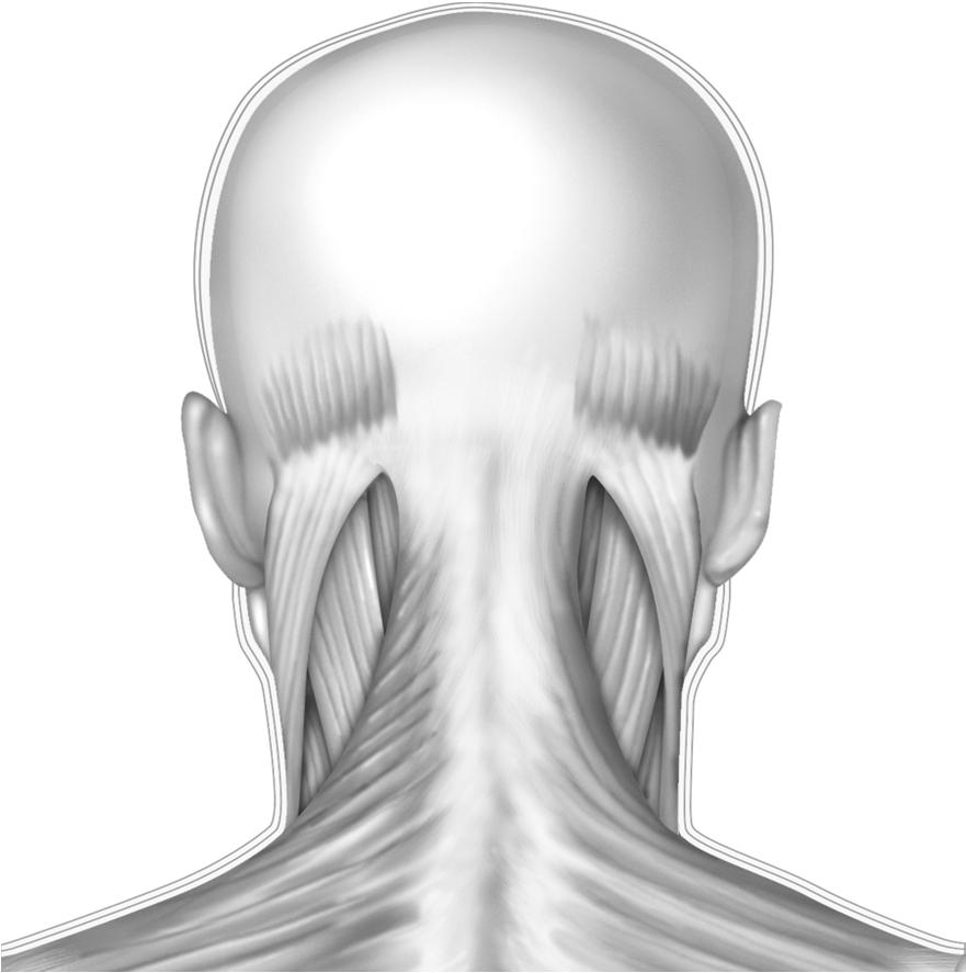 Injection Sites: Cervical Paraspinal and Trapezius 5 U ONABA (0.