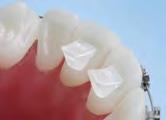 occlusal interference Comfortable for the patient Composite material will not wear enamel educes bond