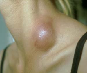 Subcutaneous abscess Immune Reconstitution in patient with AIDS And Miliary TB, on HAART Vidal J, et. al. Rev. Inst. Med. Trop. S. Paulo vol.45 no.3 São Paulo May/June 2003 http://www.itg.