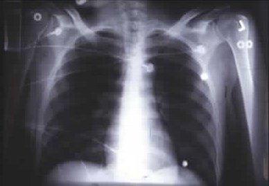 A Normal CXR rules out TB TB in Advanced AIDS