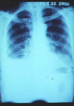 TB Pleural effusions persist if untreated Beware the