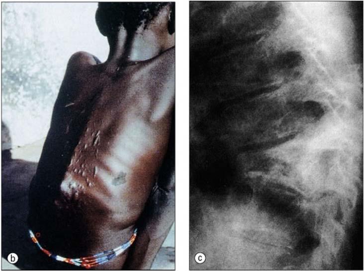 Bone and Joint TB Skeletal TB Spinal TB (Pott s disease) most common location: 40% Next most common: hip (40%) and knee