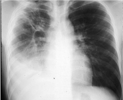 Pleural Tuberculosis 2nd most common form of extra pulmonary TB (15 20%) In