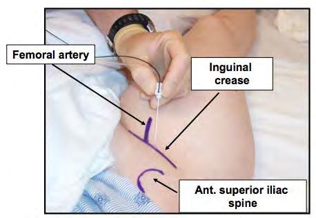 Patient is positioned in a supine position with the arm on the procedural side stationed out of the sterile field.