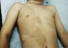 Case 2 Large, Brown Chest Patch A seven-year-old boy is noted to have a brownish patch on the right side of his chest and right upper abdomen. The child is otherwise healthy. a. Café au lait patch b.