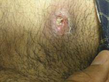 Case 4 Sore Pimple on the Buttock A 32-year-old male truck driver arrives at the clinic complaining of a sore pimple on his buttock of a few days duration.