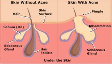 Pimples What are pimples? A pimple is a small pustule or papule. Pimples are also known as spots or zits. They are small skin lesions or inflammations of the skin.