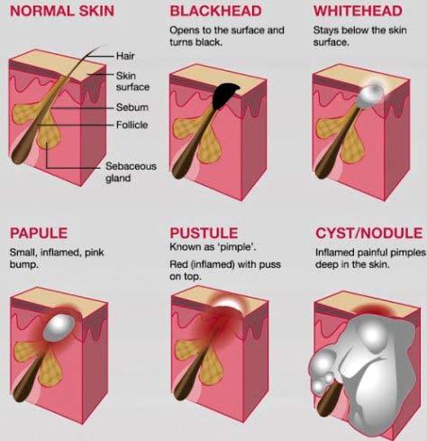 The Formation of Pimples The Development Stages of Pimples Signs and