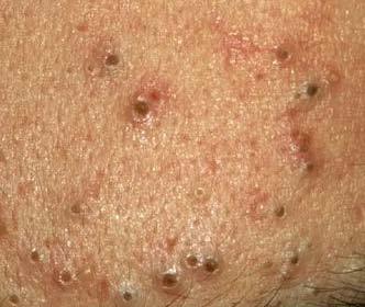 Blackheads on face (left) and