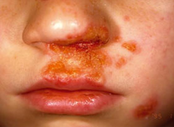 A break in the epidermal integrity can allow organisms to enter and become pathogenic. This can occur as a result of trauma, ulceration, fungal infection, skin disease such as eczema.