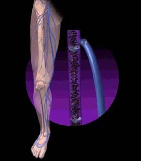 REFLUX: its contribution to varicose veins Illustration by Linda S.