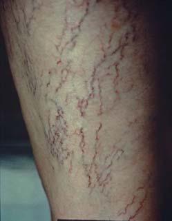 Telangiectasias Also known as spider veins due to their appearance Very common, especially in women Increase