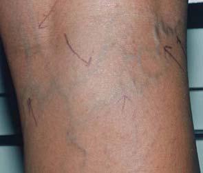 Reticular Veins Enlarged, greenish-blue appearing veins Frequently associated with clusters of