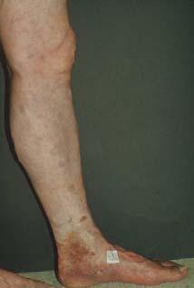 Great Saphenous Insufficiency Skin changes are seen along the medial aspect of the ankle The presence of skin