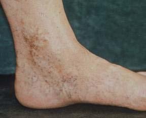 Skin changes suggestive of chronic venous insufficiency