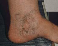 (C4a) Healed ulcer (C5) Venous Ulceration Over 50% of