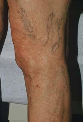 93 Treatment of telangiectasias Sclerotherapy most effective