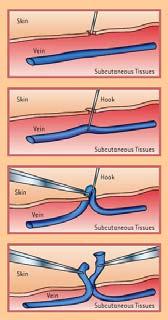 Surgical Treatment of Varicose Veins: Phlebectomy Very esthetic method of removing varicose