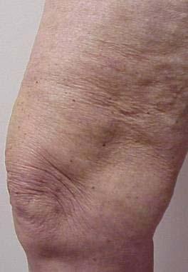 Great Saphenous Vein and