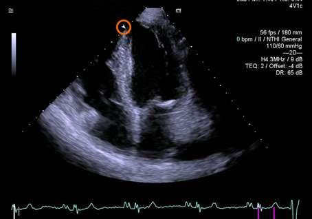 TEE view of the mitral valve with True Volume Color Doppler using the