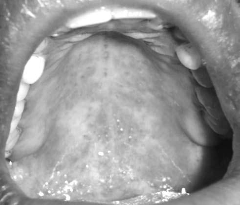 Figure 1. Diffuse erythema of soft palate. Figure 3. Erythematous lesions on right buccal mucosa. Figure 2. Erosive lesions on ventral surface of tongue.
