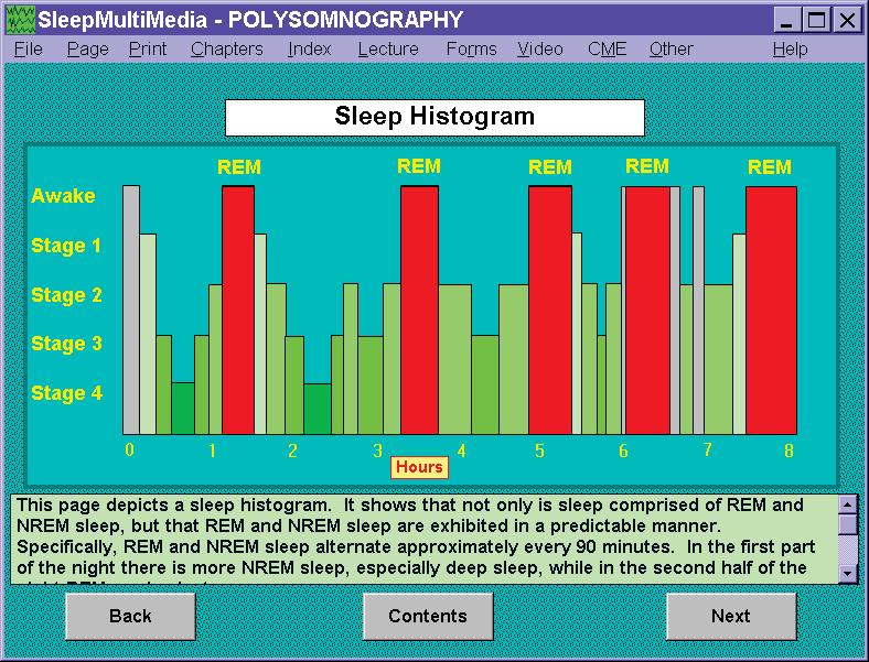 Reminder of Normal Sleep Physiology 2 types of sleep (REM, NREM) NREM has 4 stages, stage III and IV called slow wave sleep Slow wave sleep predominates in first 1/3 of night REM sleep predominates