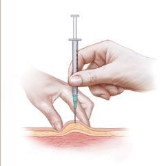 SUBCUTANEOUS INJECTION ONLY 4. Hold the syringe like a pencil or dart with your right hand if you are right-handed and your left if you are left-handed.
