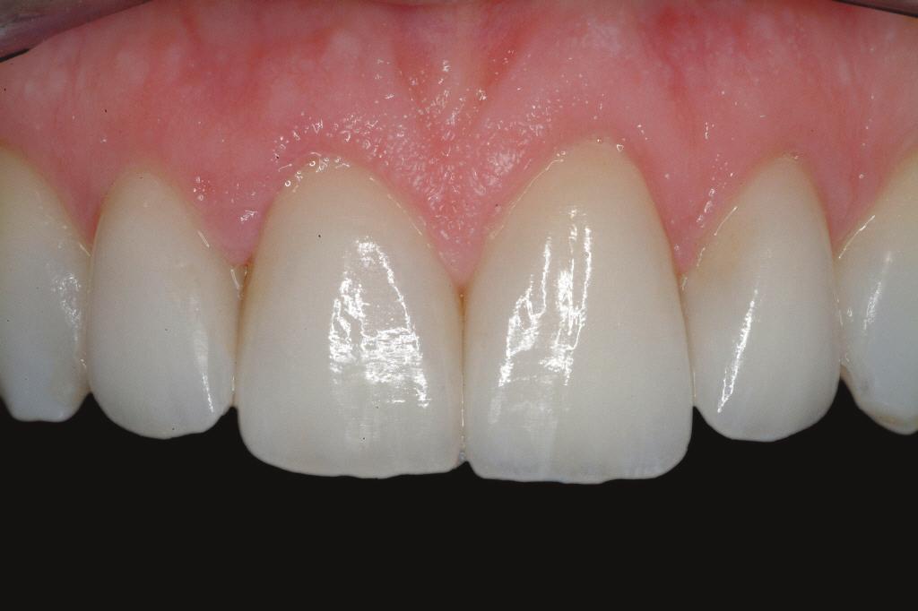 This article demonstrates clinical considerations and treatment sequences (ie, treatment planning, preparation, provisionalization, cementation) using a series of detailed case presentations.