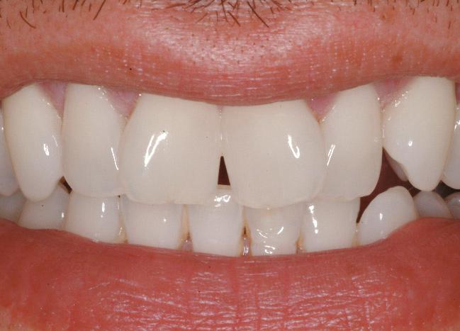 predictable, longer-lasting solution, namely porcelain veneers, a clinical examination was conducted.