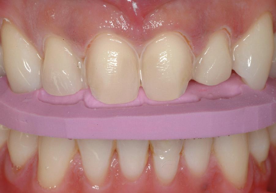 Preparation Since there was gingival zenith disparity between the central incisors, a diode laser (ie, DiolasePlus, Biolase, Irvine, CA) was used to correct it prior to tooth preparation.